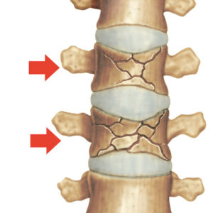Spine Fracture