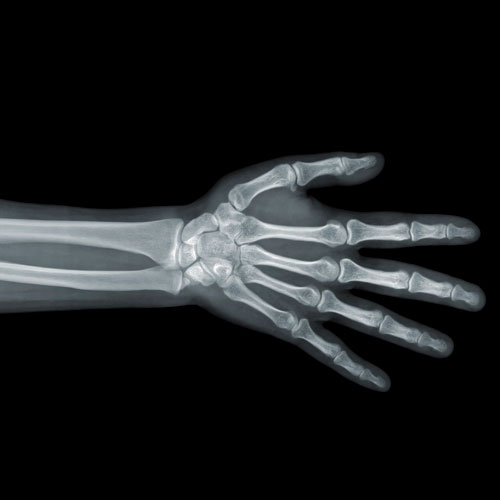 Hand Xray