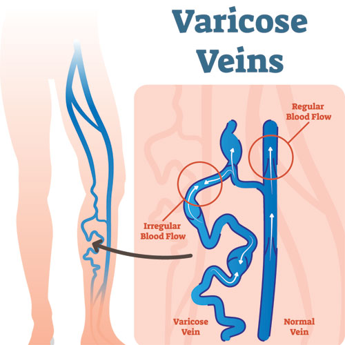 Varicose Vein Illustration